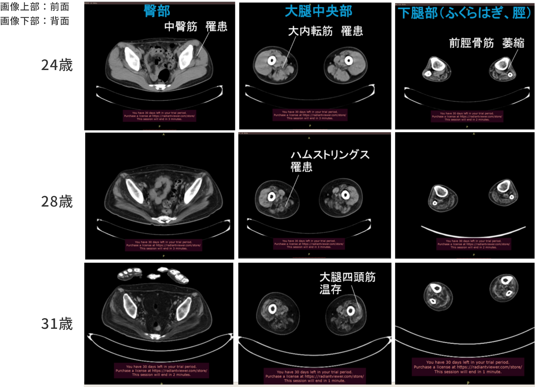 GNEミオパチーのCT画像(筋障害の進行)