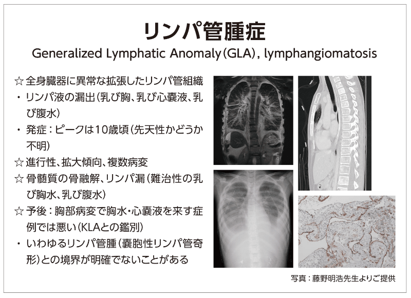 リンパ管腫症（GLA）