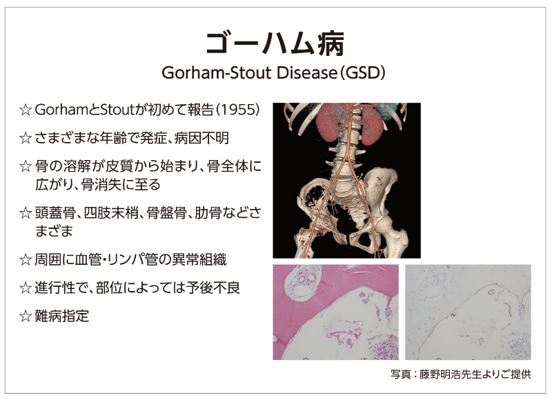 ゴーハム病(GSD)