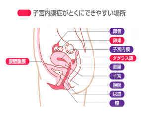 子宮内膜症がとくにできやすい場所