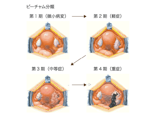 ビーチャム分類の図