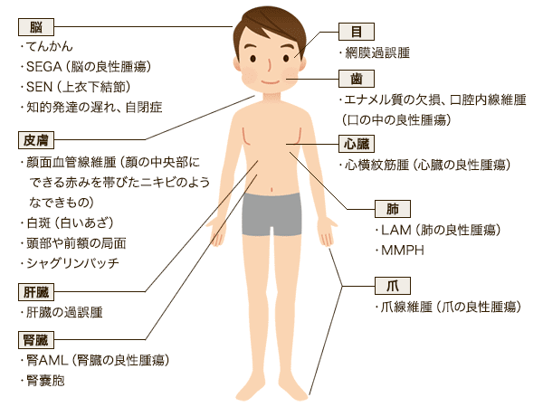 結節性硬化症の症状