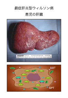 劇症肝炎型ウィルソン病患児の肝臓