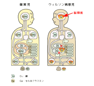 ウィルソン病患児の脳障害の図