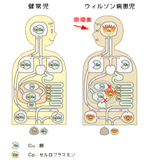 ウィルソン病患児の眼障害の図