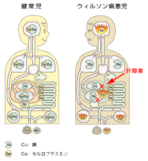 ウィルソン病患児の肝障害の図