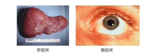 肝症状 眼症状