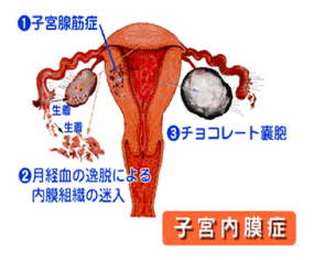 子宮内膜症の図解