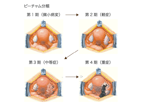 ビーチャム分類の図解