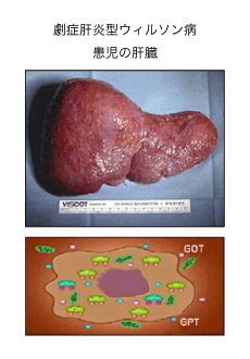 劇症肝炎型ウィルソン病患児の肝臓写真